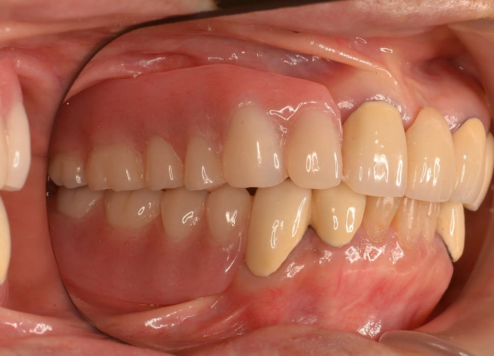 コーヌス義歯