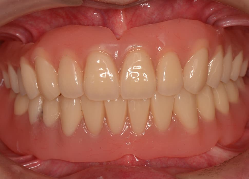 インプラントオーバー義歯