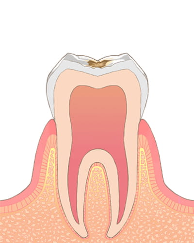 【う蝕の程度】C1→ムシ歯の中期状態