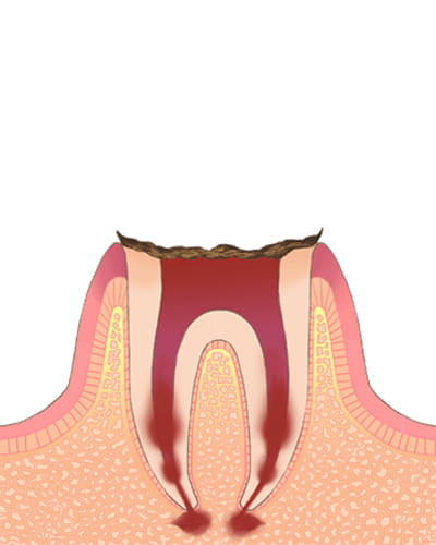 【う蝕の程度】C0→ムシ歯の初期状態合