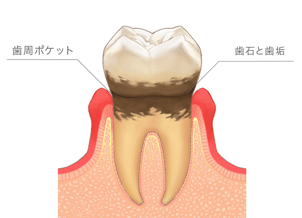 歯周病の最大の原因は歯の汚れ