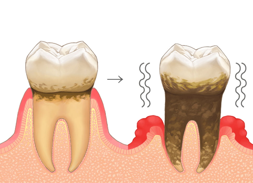 歯周病の症状の進み順