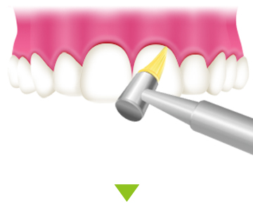 PMTC 歯と歯の隙間を清掃