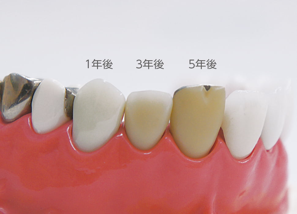 歯科用プラスチック素材の経年変化
